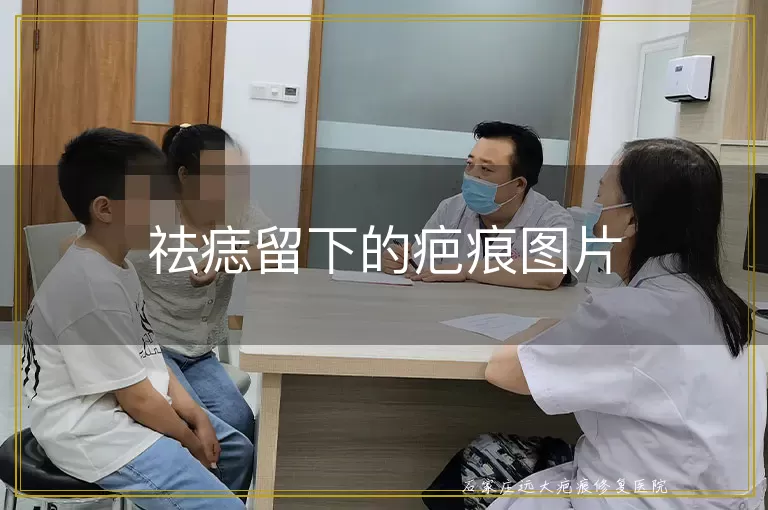 祛痣留下的疤痕图片