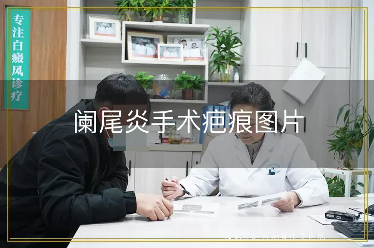 阑尾炎手术疤痕图片
