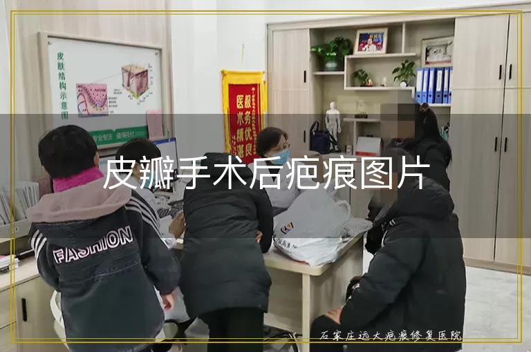 皮瓣手术后疤痕图片