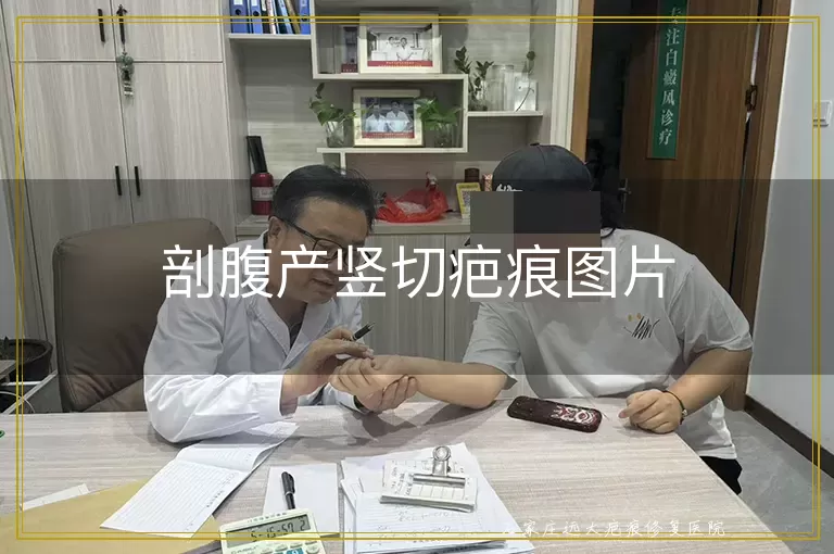 剖腹产竖切疤痕图片