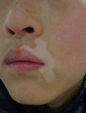 儿童|孩子脸上有白斑
