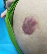增生性疤痕