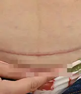 剖腹产疤痕