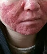 烧烫伤疤痕