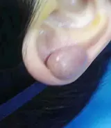 疤痕疙瘩