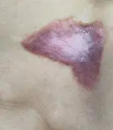 挛缩性疤痕
