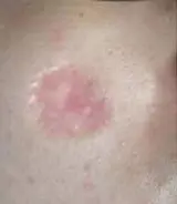 凹陷性疤痕