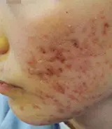 痤疮疤痕