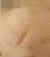 色素性疤痕