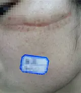 外伤疤痕