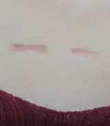 表浅性疤痕