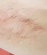 萎缩性疤痕
