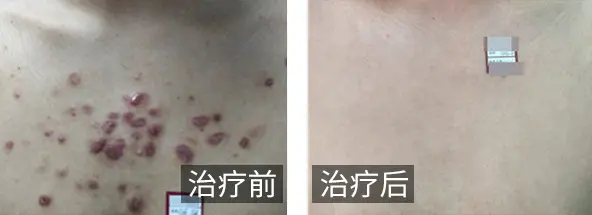 烫伤疤痕