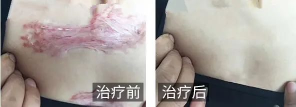 外伤疤痕
