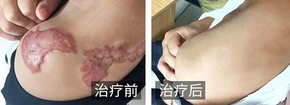手术疤痕