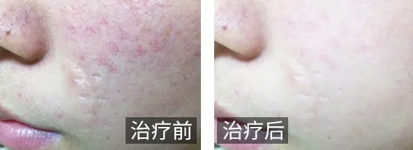 疤痕疙瘩